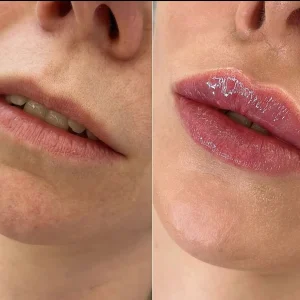 efekt-przed-i-po-modelowanie-ust