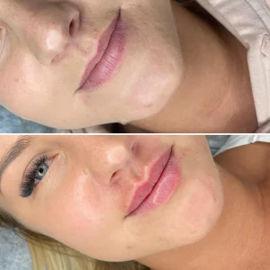 metamorfoza-powiekszania-ust-ostrow-mazowiecka