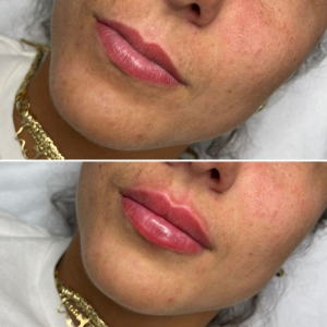 klientka-po-zabiegu-powiekszaniu-ust