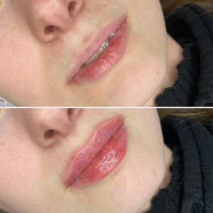 efekt-przed-i-po-klientka-po-powiekszania-ust